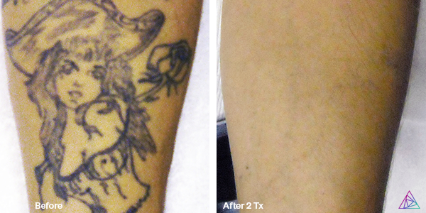 Before and after tattoo removal